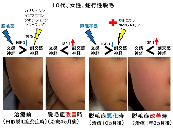 円形脱毛症　病院
